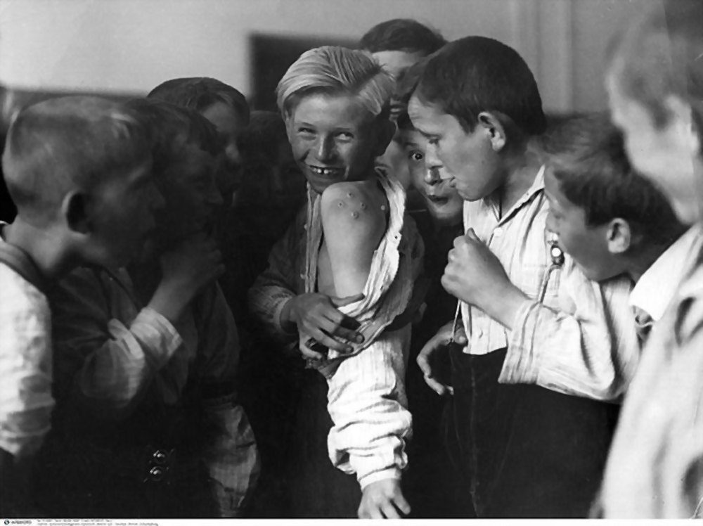 Ssmallpox, immunization, vaccination, boy with characteristic vaccination scars, 1930s